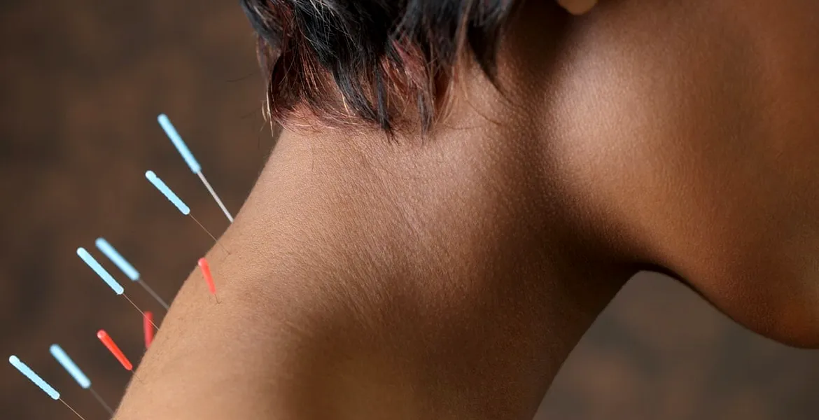 Sportul și tratamentul prin acupunctură – de ce sportivii trebuie să apeleze la această metodă