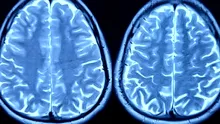 Boala care oprește formarea de noi neuroni